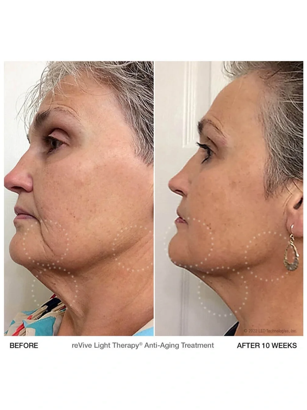 reVive Lux Collection dpl IIa - LED Treatment Panel Skin Care Light Therapy
